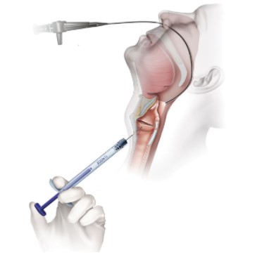 Cricothyroid Cartilage Approach