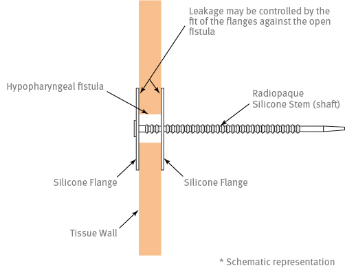 Fistula Prosthesis Placement & Function