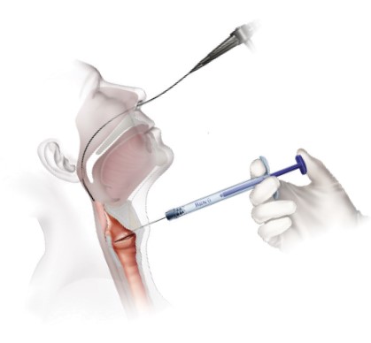 Thyroid Approach