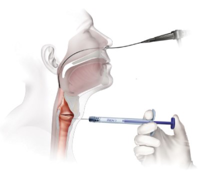 Thyroid Cartilage Approach